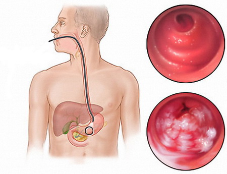 gastrit 2